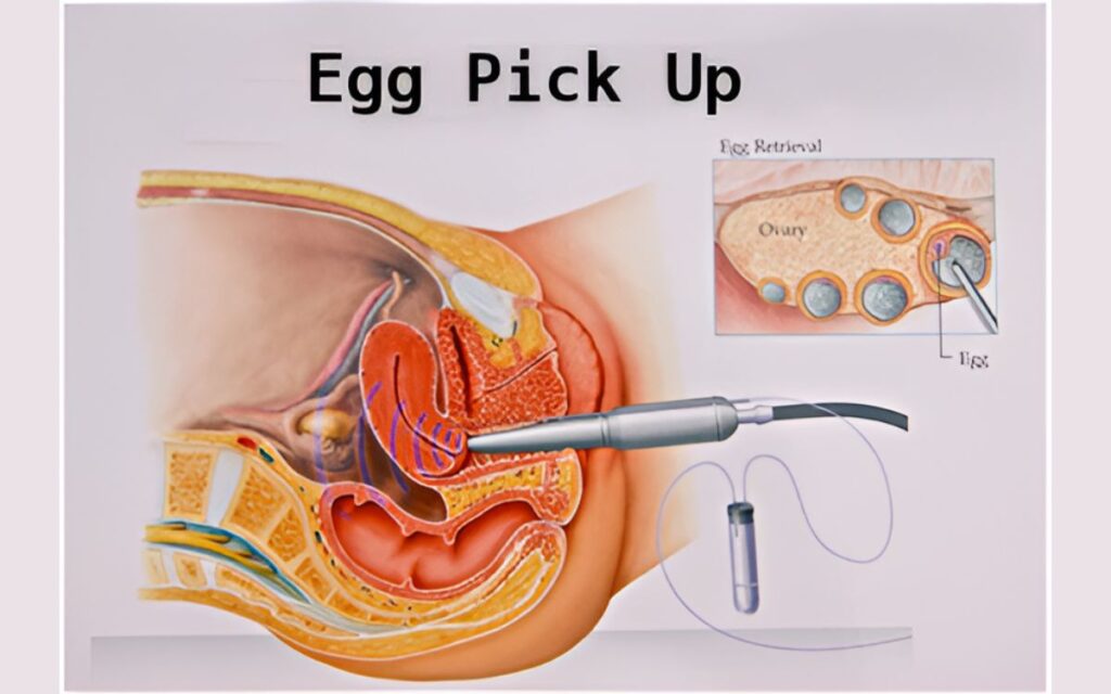 IVF Egg Pick up Procedure