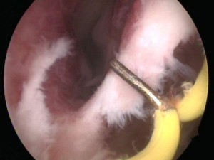 Septum Resection Hysteroscope