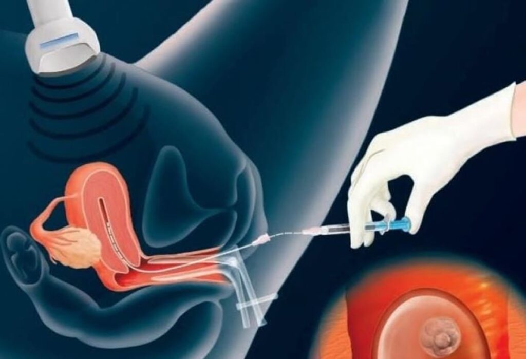 Embryo Transfer Procedure