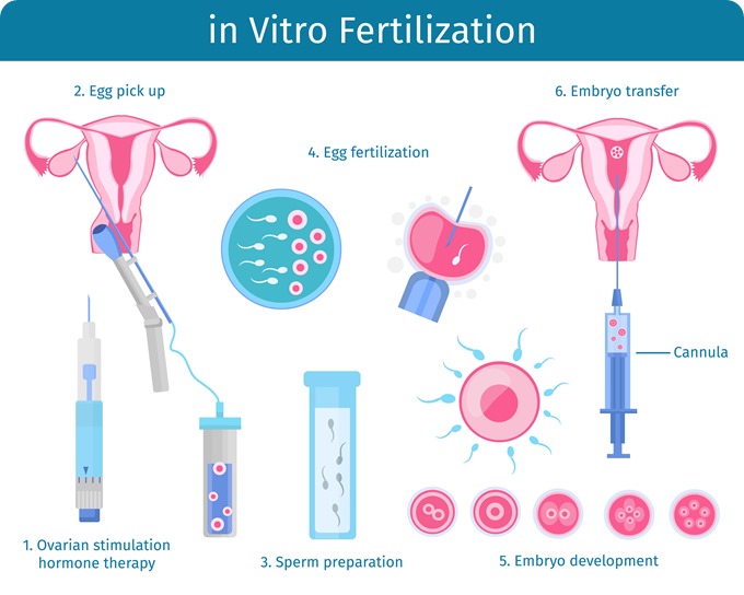 ivf-treatment-in-tamilnadu